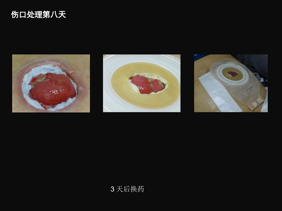 结肠肠造口术后皮肤黏膜分离个案护理_第13页