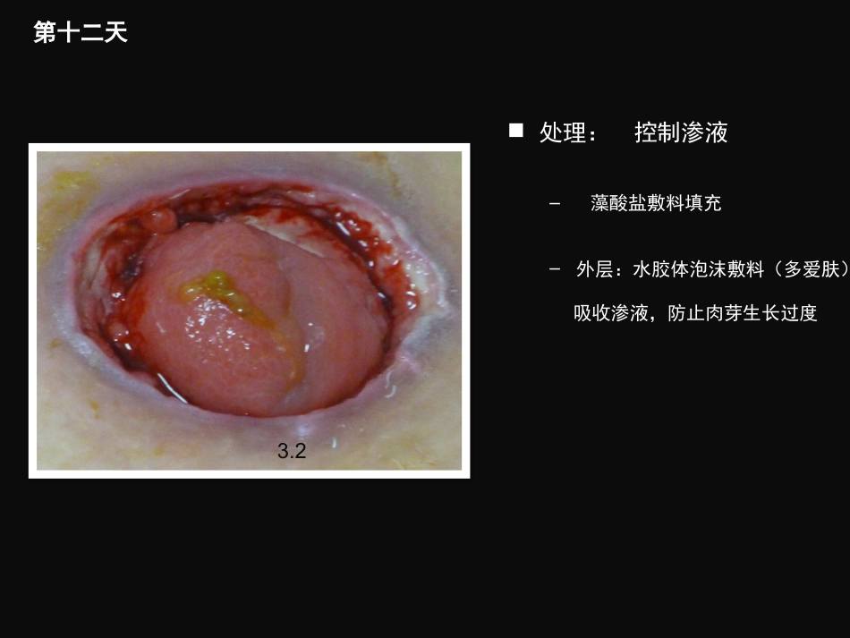 结肠肠造口术后皮肤黏膜分离个案护理_第14页