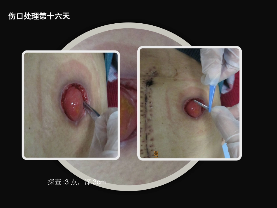 结肠肠造口术后皮肤黏膜分离个案护理_第15页