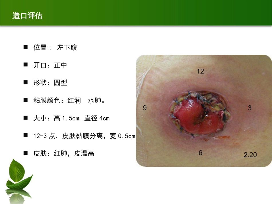 结肠肠造口术后皮肤黏膜分离个案护理_第4页