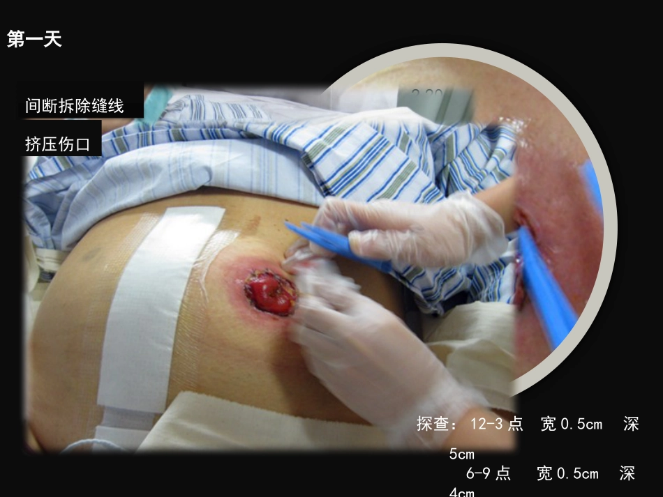 结肠肠造口术后皮肤黏膜分离个案护理_第6页