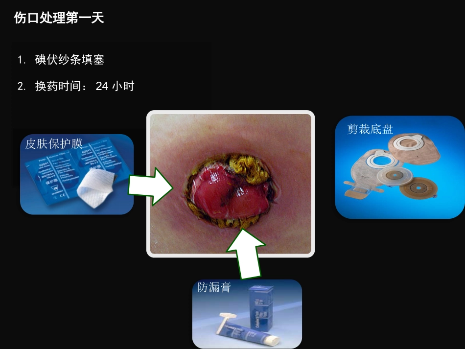 结肠肠造口术后皮肤黏膜分离个案护理_第7页