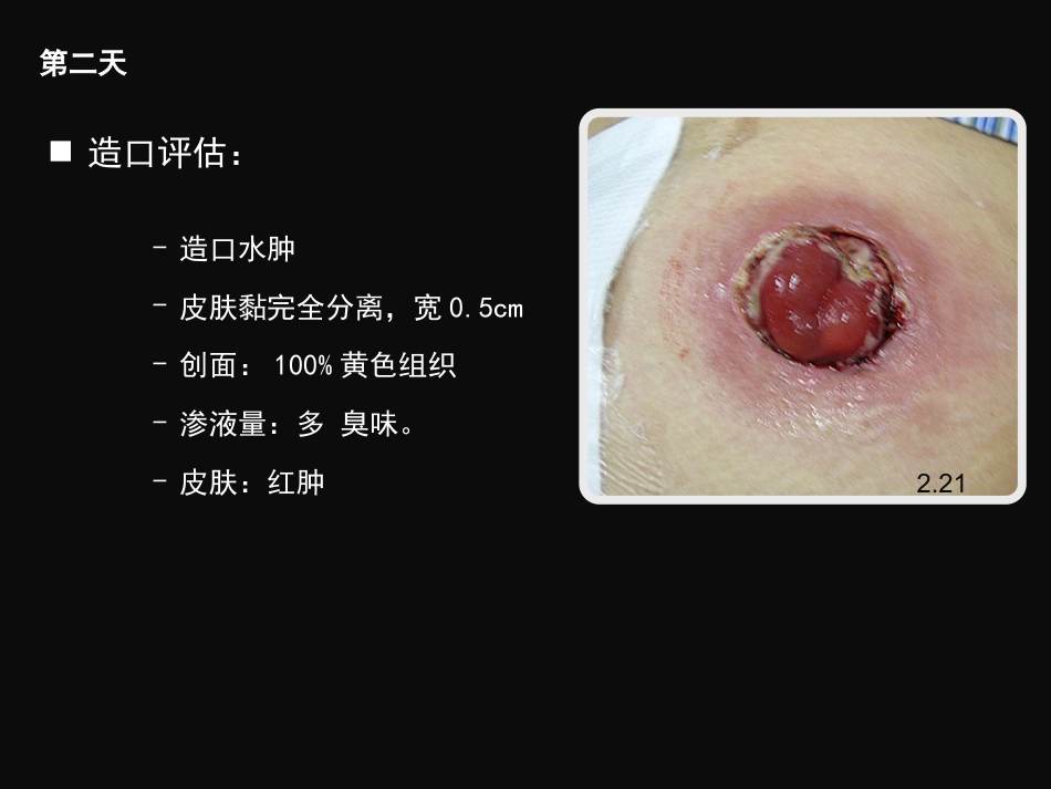 结肠肠造口术后皮肤黏膜分离个案护理_第8页