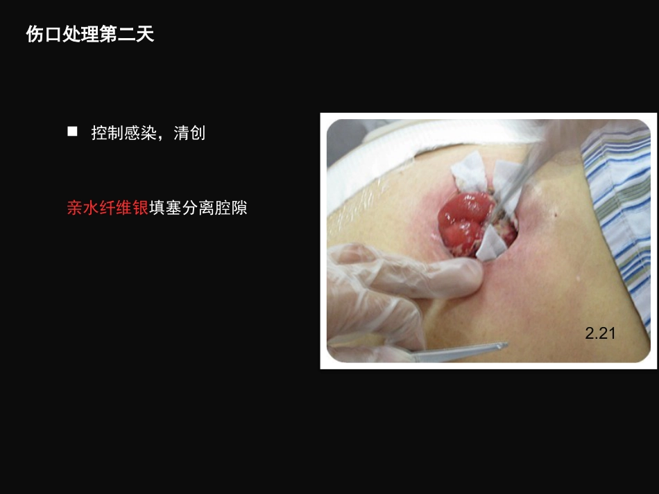 结肠肠造口术后皮肤黏膜分离个案护理_第9页