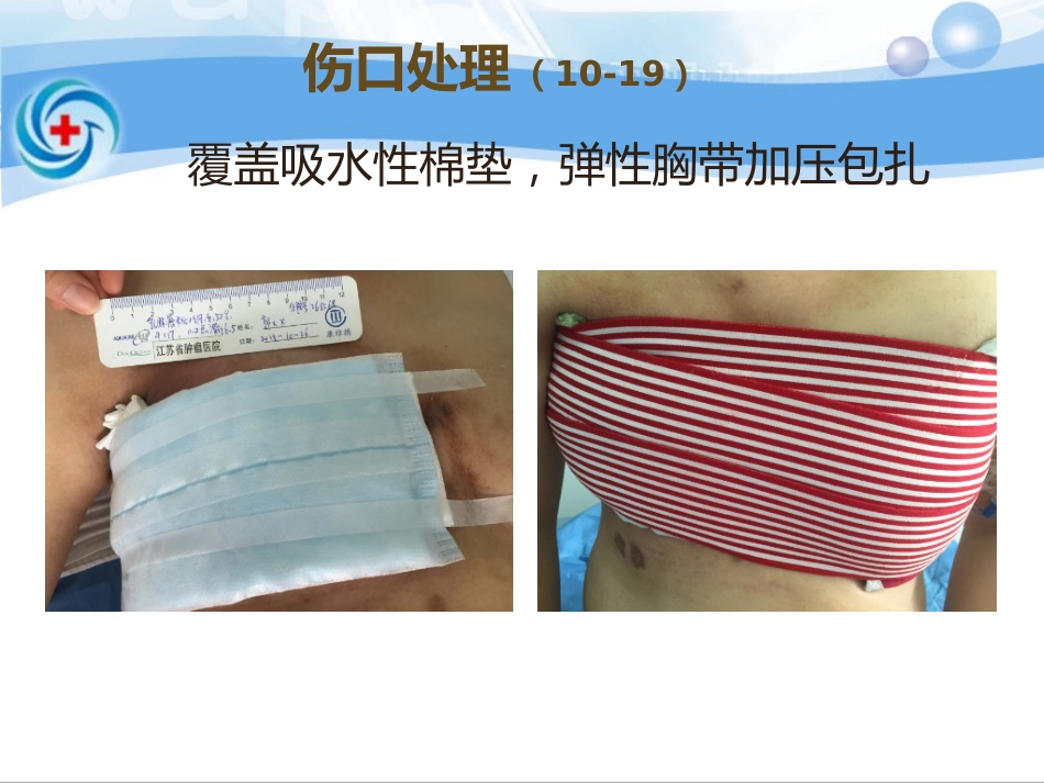 一案乳腺癌术后皮瓣坏死患者的处理_第10页