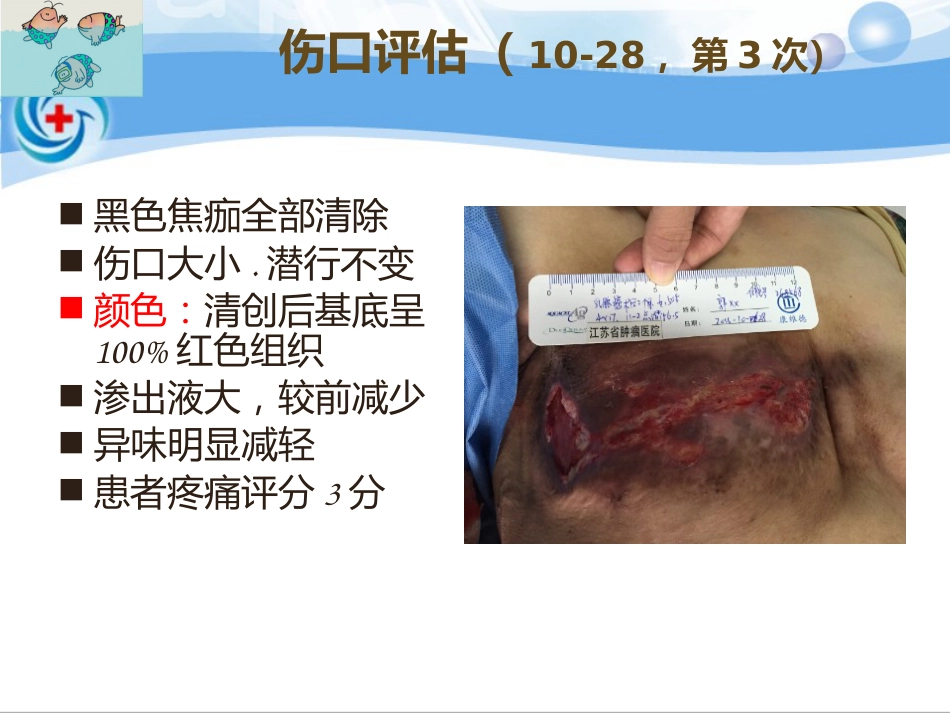 一案乳腺癌术后皮瓣坏死患者的处理_第13页