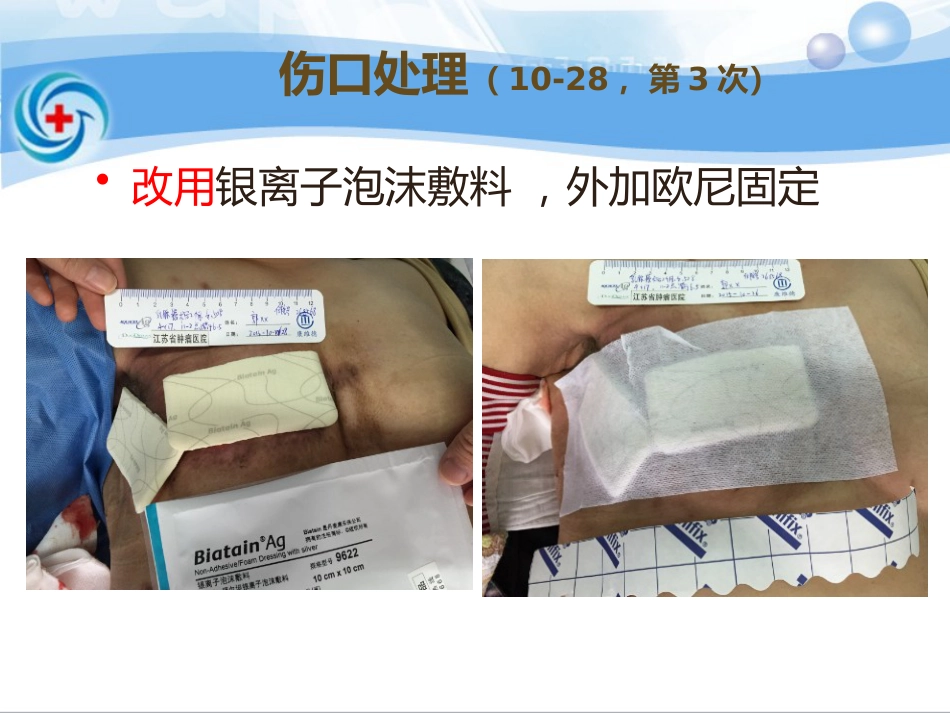 一案乳腺癌术后皮瓣坏死患者的处理_第14页