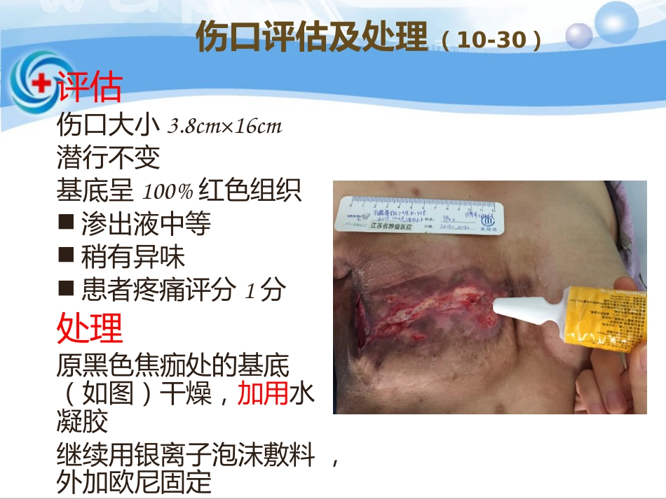 一案乳腺癌术后皮瓣坏死患者的处理_第15页