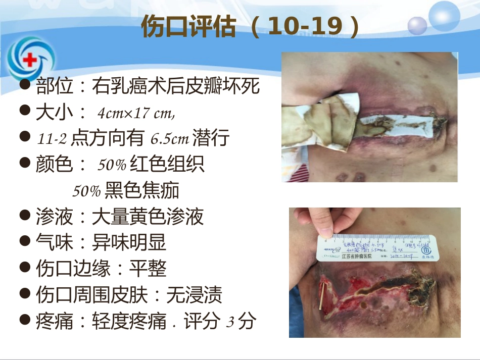 一案乳腺癌术后皮瓣坏死患者的处理_第5页