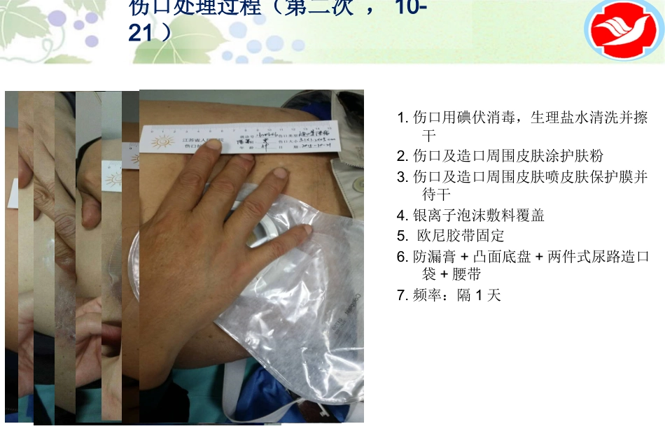 一例泌尿造口患者的护理_第10页