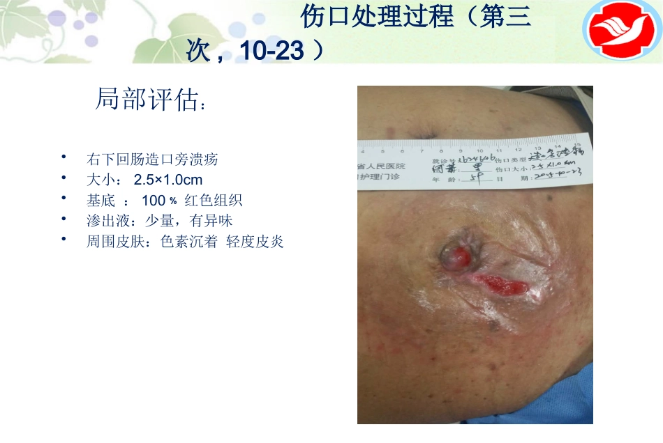 一例泌尿造口患者的护理_第11页