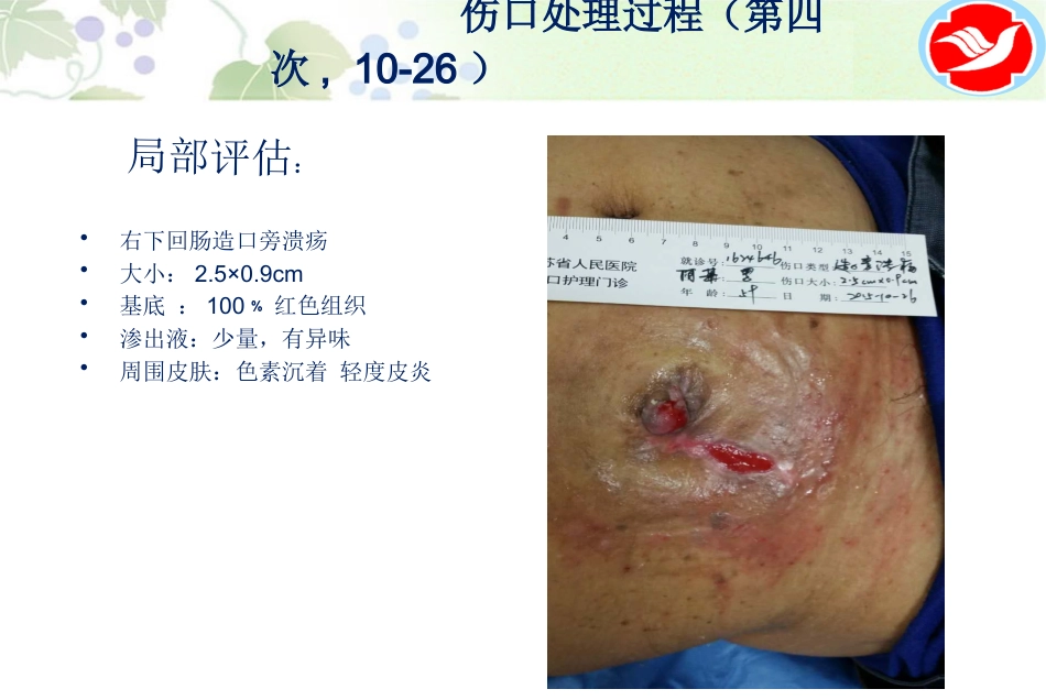 一例泌尿造口患者的护理_第13页