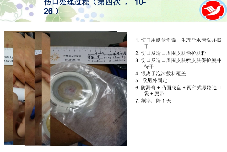 一例泌尿造口患者的护理_第14页