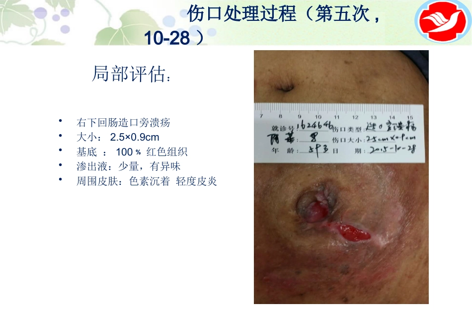 一例泌尿造口患者的护理_第15页