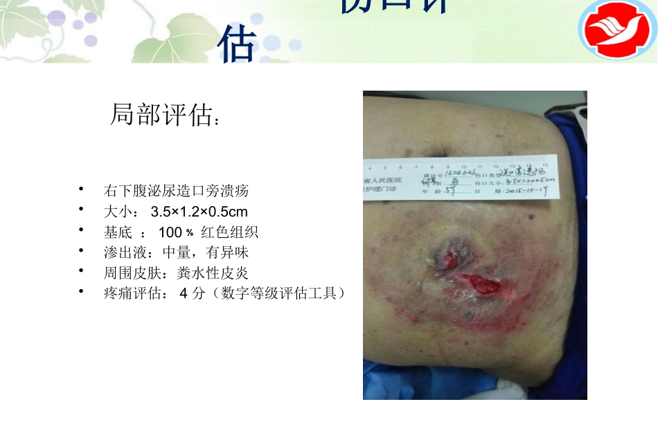 一例泌尿造口患者的护理_第5页