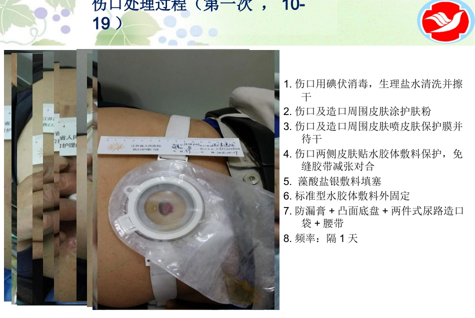 一例泌尿造口患者的护理_第8页