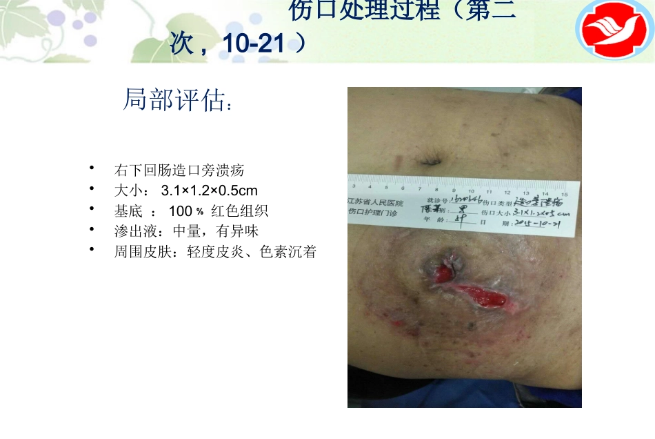 一例泌尿造口患者的护理_第9页