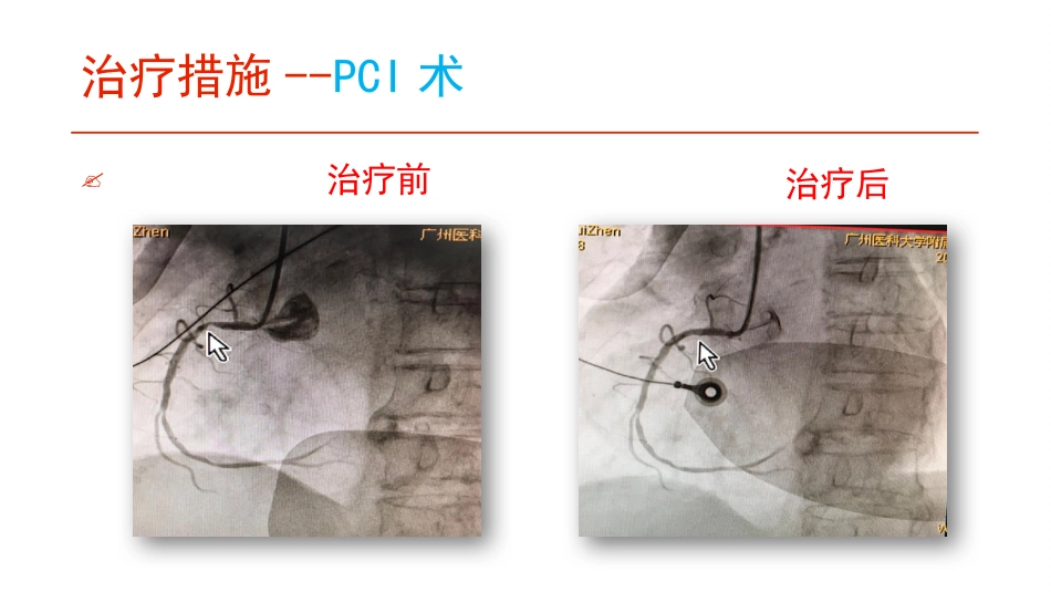 一例急性心肌梗死PCI术后心脏早期康复的护理_第8页