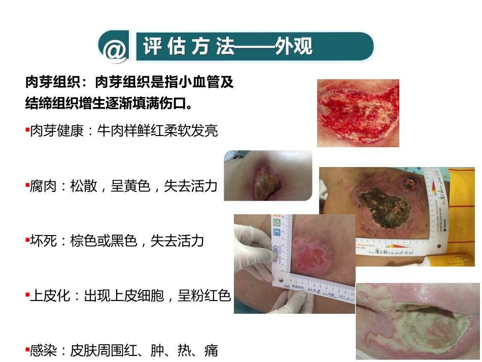 糖尿病压疮伤口个案_第10页