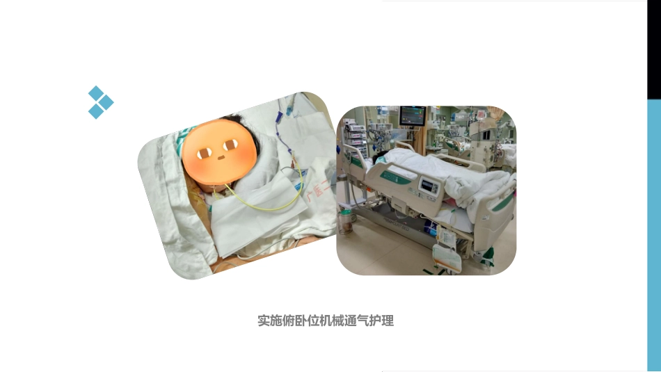 一例1型呼吸衰竭合并2型糖尿病患者实施俯卧位通气的个案分享_第15页