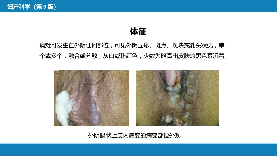 外阴肿瘤._第11页