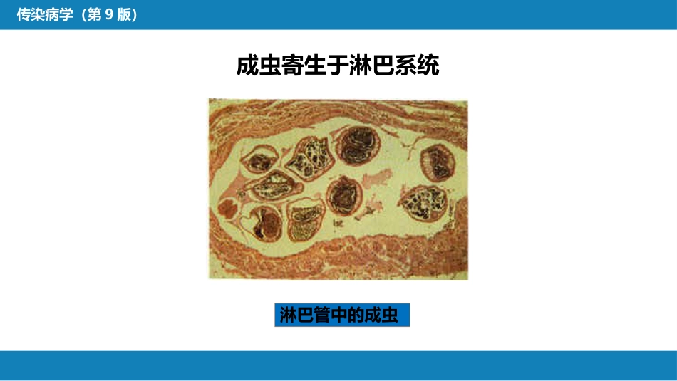 第八章 蠕虫病 第二节 丝虫病_第11页