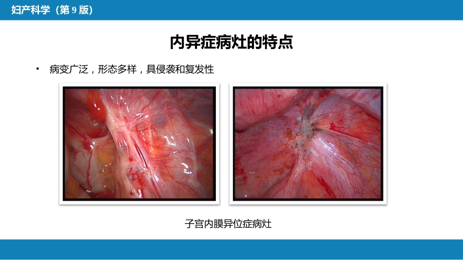 子宫内膜异位症与子宫腺肌病_第14页