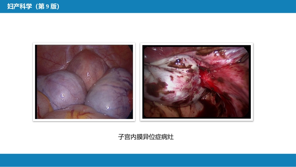 子宫内膜异位症与子宫腺肌病_第15页