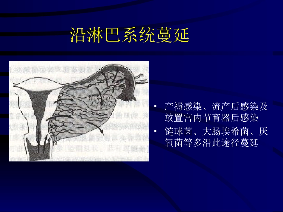 妇产科-盆腔炎_第13页