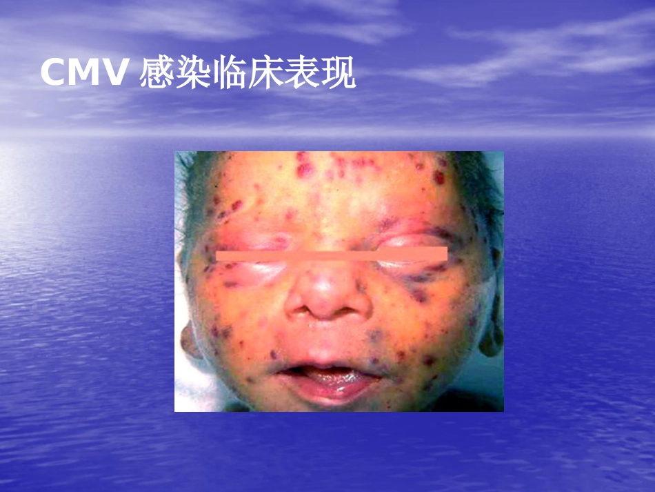 先天巨细胞病毒感染_第15页