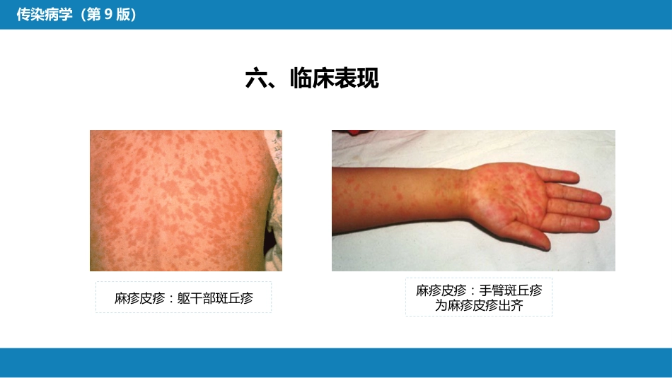 第二章 病毒性传染病 第四节 麻疹_第12页