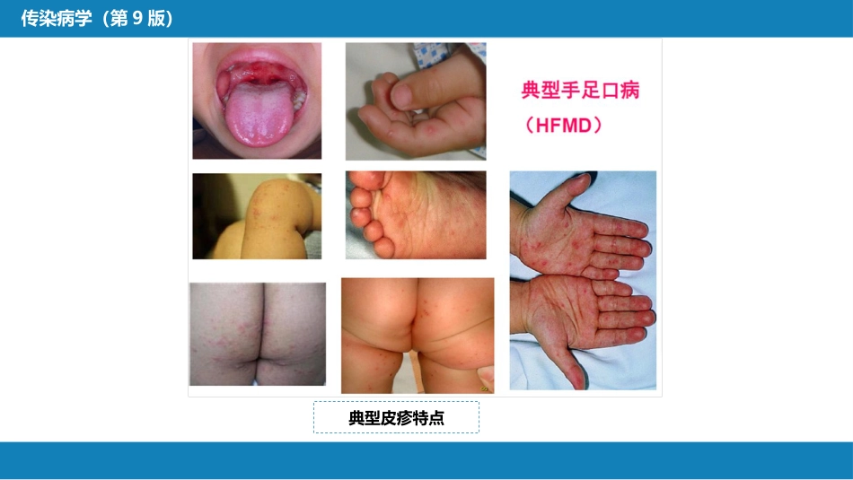 第二章 病毒性传染病 第二节 肠道病毒感染 手足口病+病毒感染性腹泻_第11页