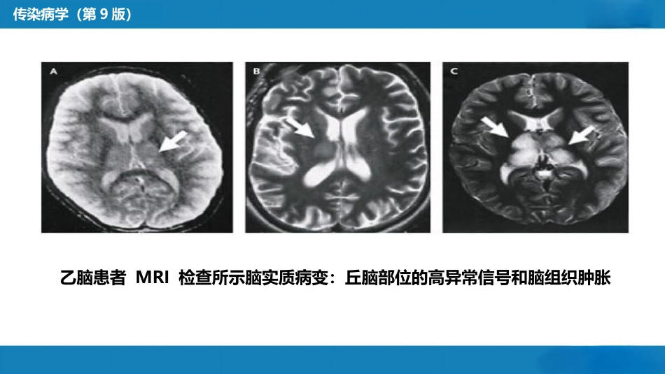 第二章 病毒性传染病 第八节 流行性乙型脑炎_第15页