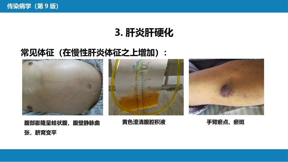 第二章 病毒性传染病 第一节 病毒性肝炎（二）_第11页