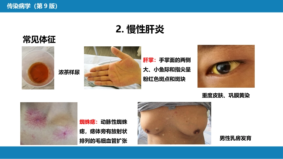 第二章 病毒性传染病 第一节 病毒性肝炎（二）_第9页