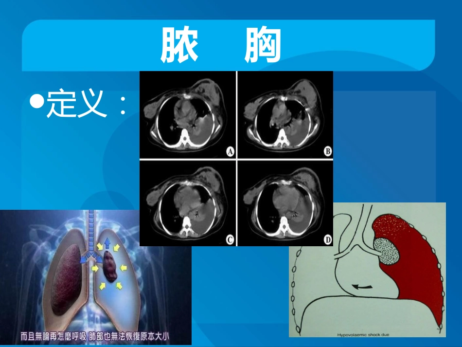 传染科-脓胸_第4页
