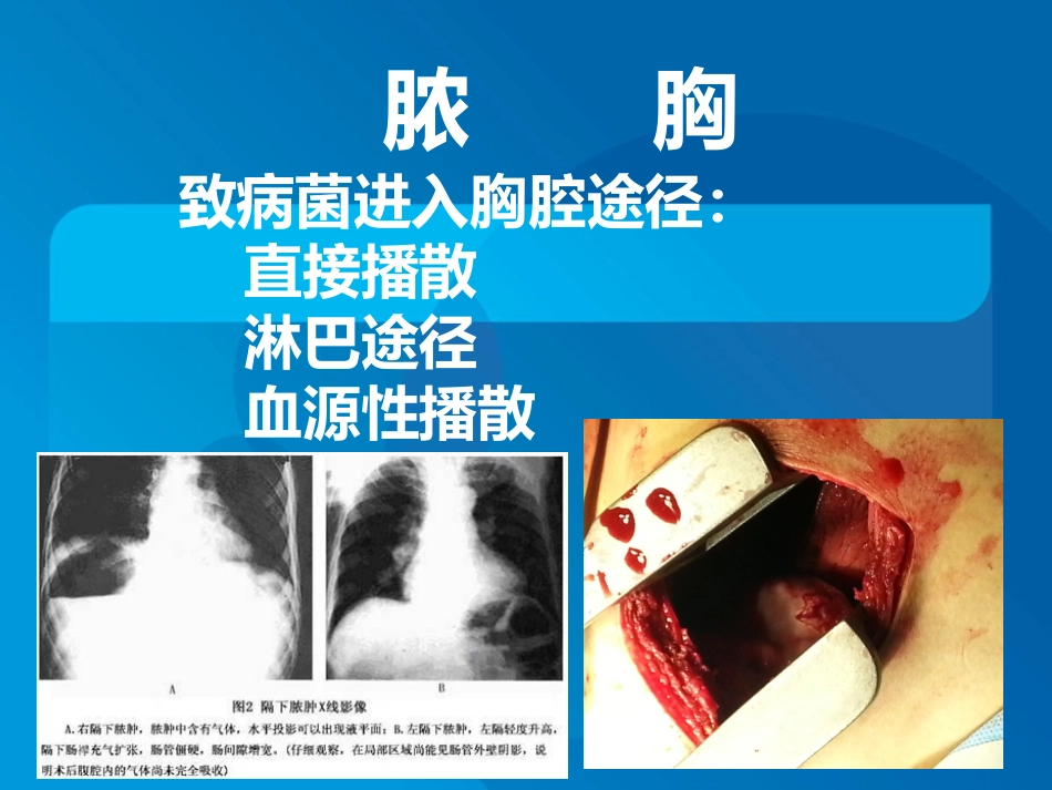 传染科-脓胸_第8页