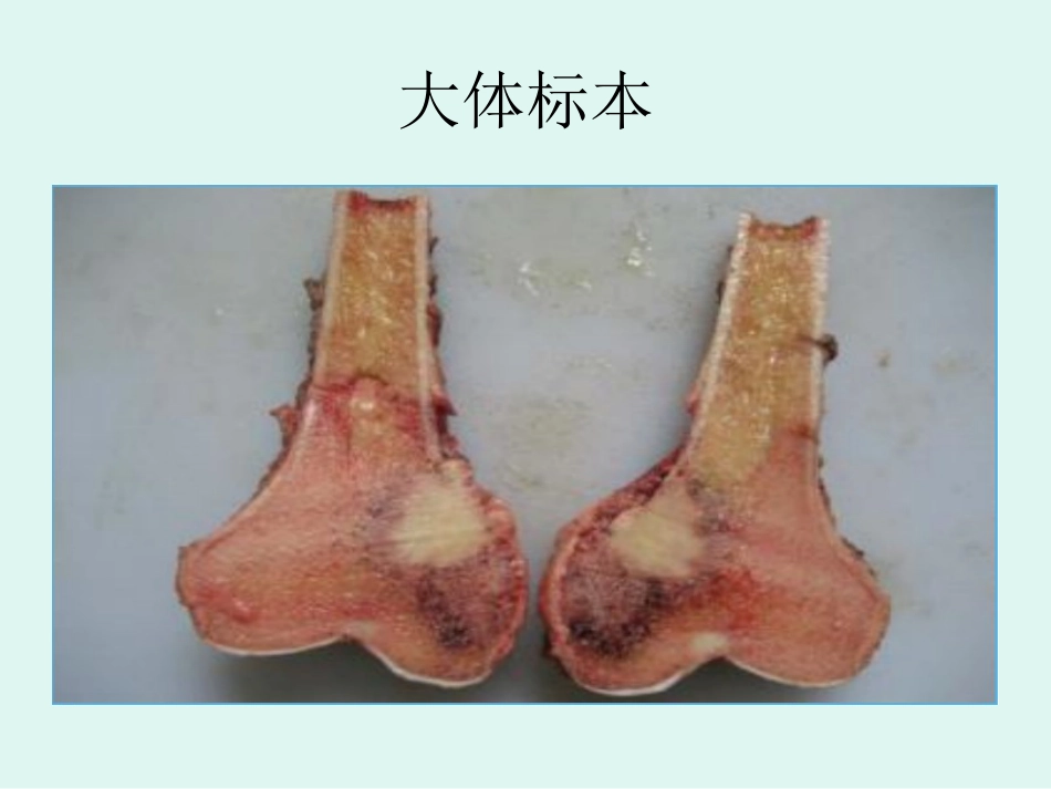 骨肉瘤的影像学诊断_第9页