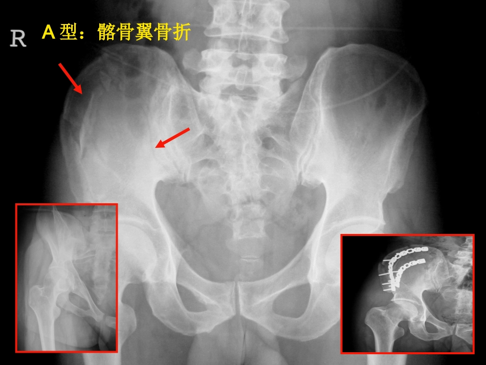 骨盆骨折急诊处理的一般原则_第14页