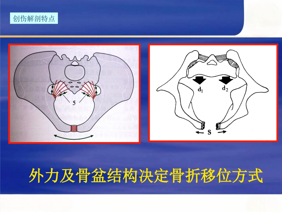 骨盆骨折急诊处理的一般原则_第6页
