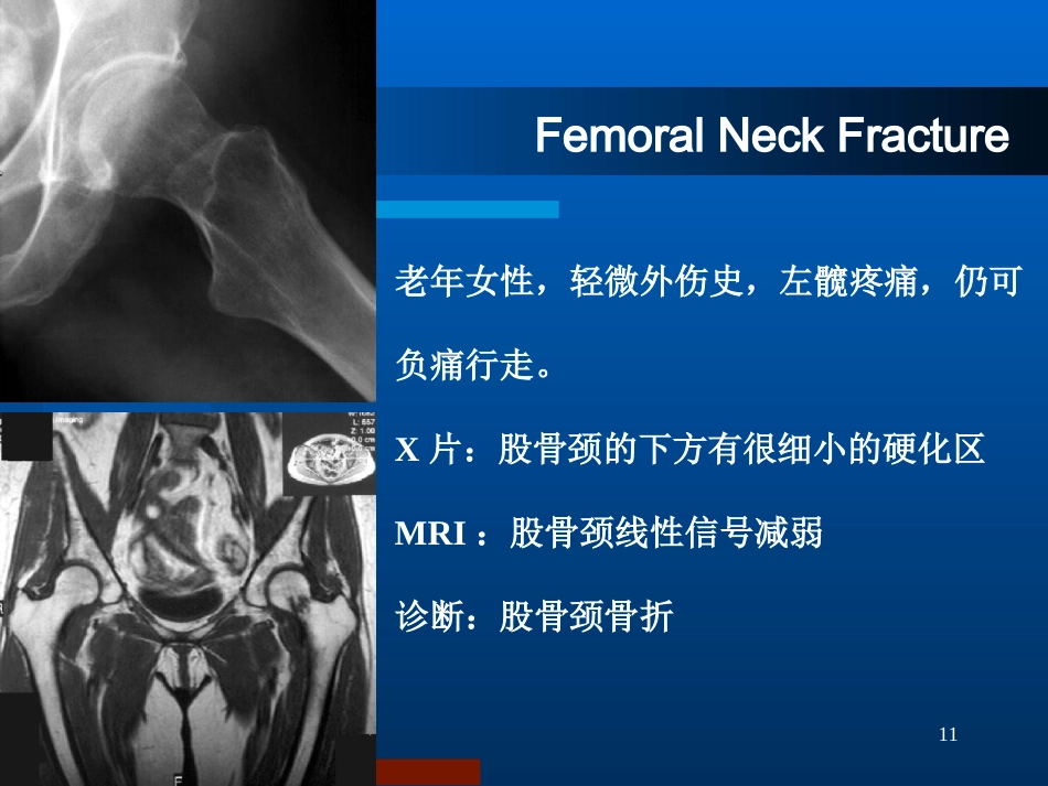 股骨颈骨折治疗选择_第11页