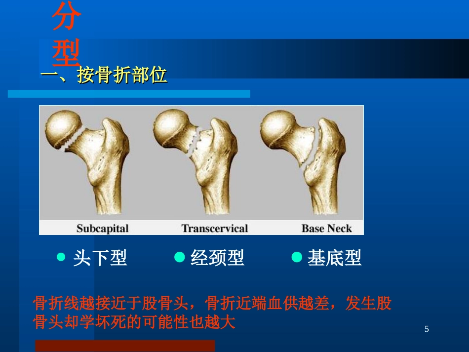 股骨颈骨折治疗选择_第5页