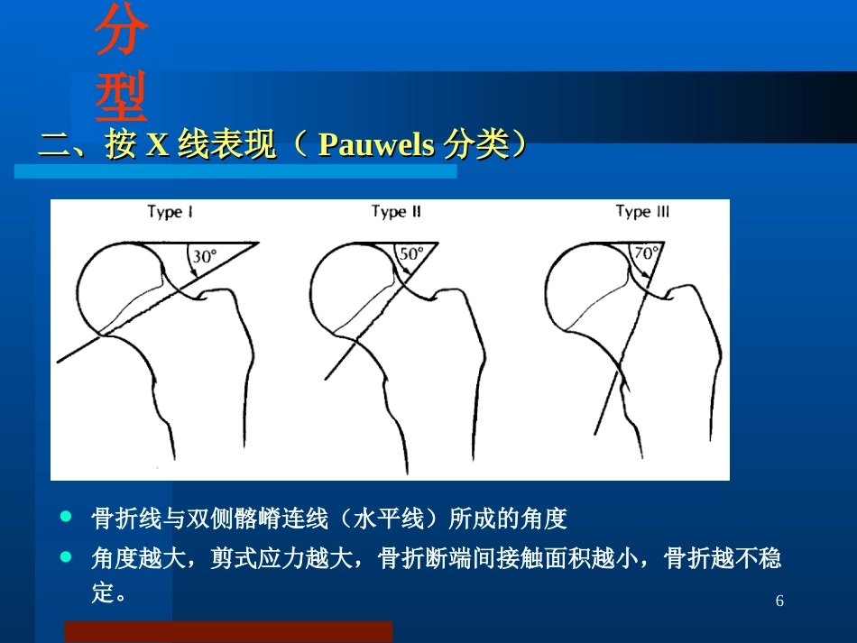 股骨颈骨折治疗选择_第6页