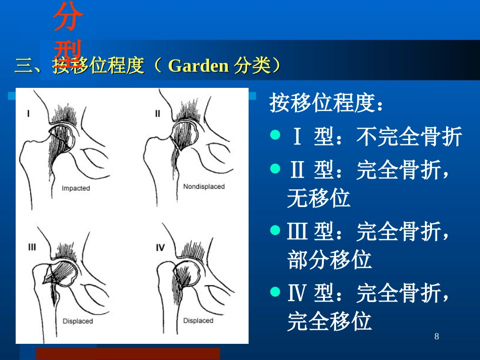 股骨颈骨折治疗选择_第8页