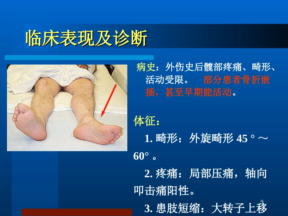 股骨颈骨折治疗选择_第9页