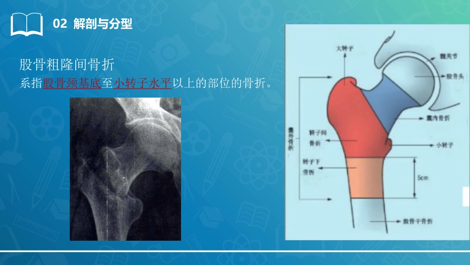股骨粗隆间骨折-_第12页