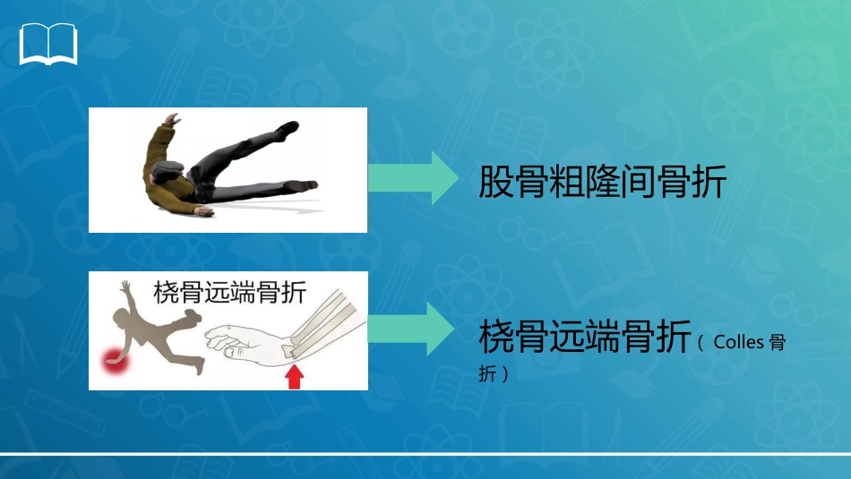 股骨粗隆间骨折-_第2页