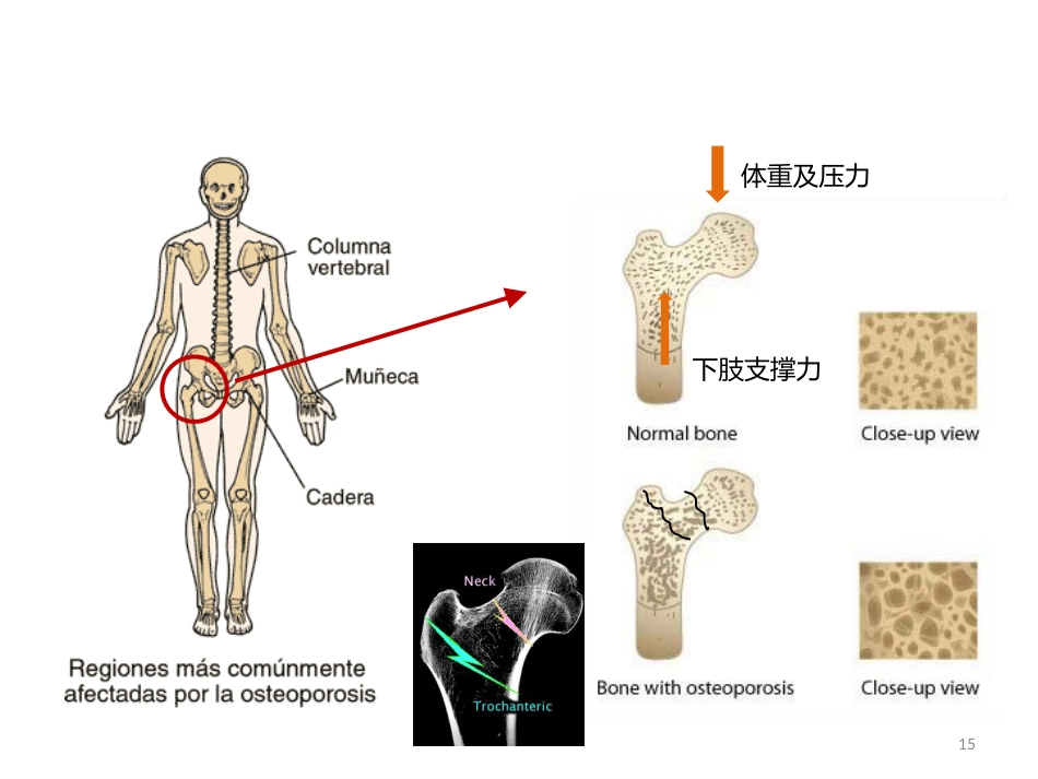 骨质疏松的诊断与治疗_第15页