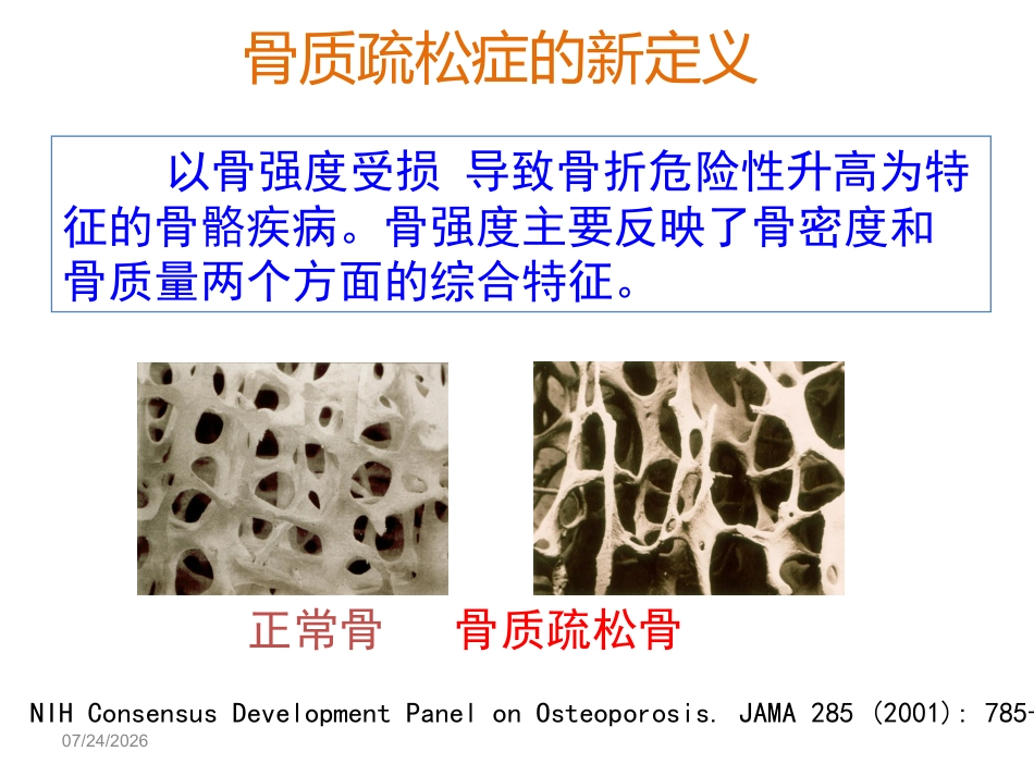 骨质疏松的诊断与治疗_第2页