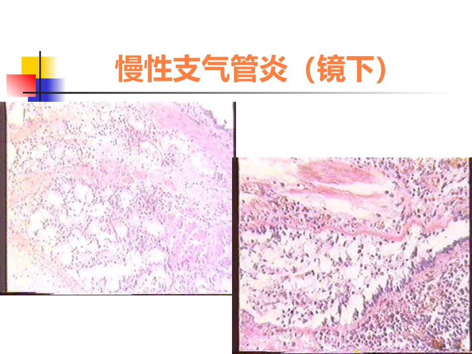 病理学呼吸疾病ppt课件_第12页